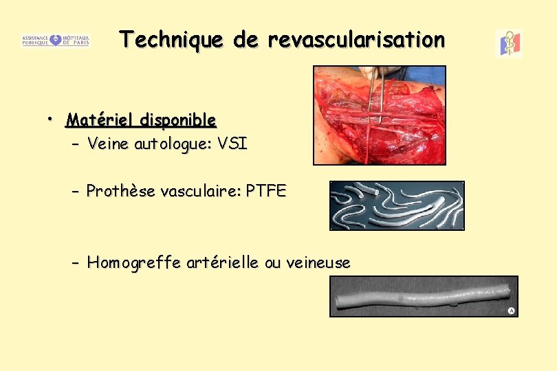 Technique de revascularisation • Matériel disponible – Veine autologue: VSI – Prothèse vasculaire: PTFE