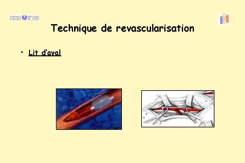 Technique de revascularisation • Lit d’aval 