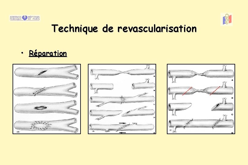 Technique de revascularisation • Réparation 