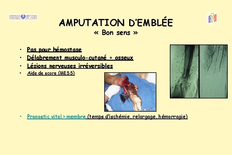 AMPUTATION D’EMBLÉE « Bon sens » • • • Pas pour hémostase Délabrement musculo-cutané