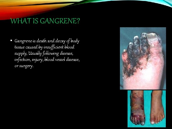 WHAT IS GANGRENE? • Gangrene is death and decay of body tissue caused by