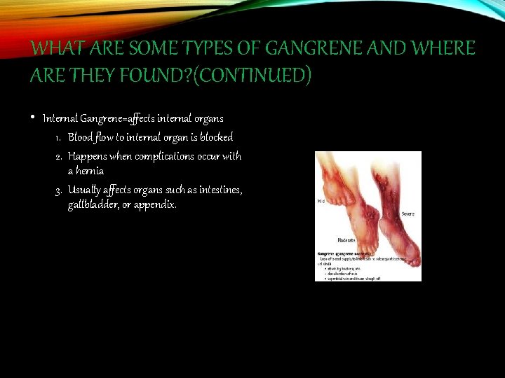 WHAT ARE SOME TYPES OF GANGRENE AND WHERE ARE THEY FOUND? (CONTINUED) • Internal