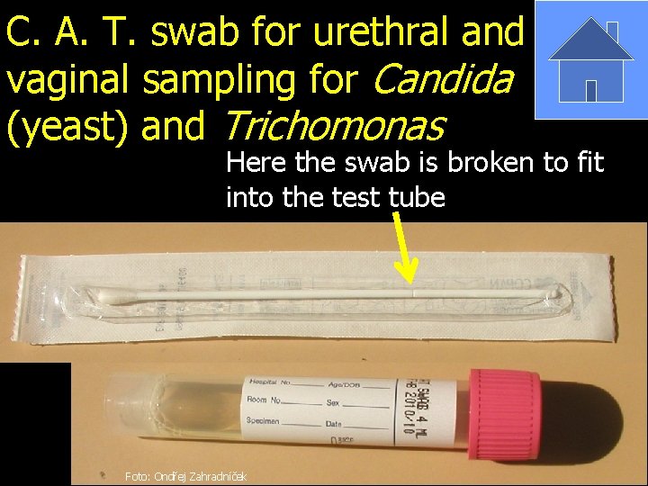 C. A. T. swab for urethral and vaginal sampling for Candida (yeast) and Trichomonas