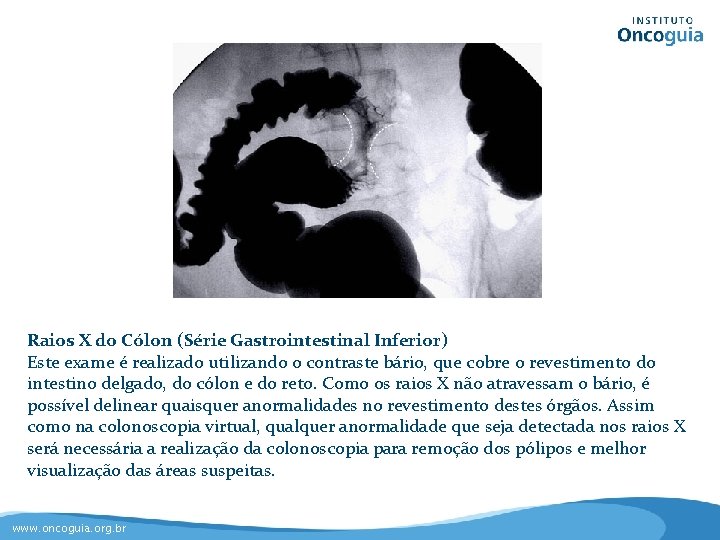 Raios X do Cólon (Série Gastrointestinal Inferior) Este exame é realizado utilizando o contraste