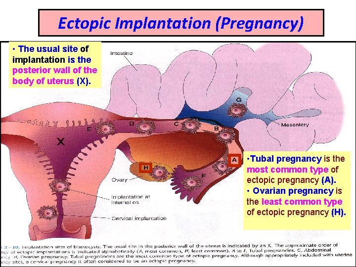 Ectopic Implantation (Pregnancy) • The usual site of implantation is the posterior wall of