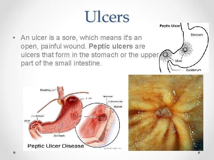 Ulcers • An ulcer is a sore, which means it's an open, painful wound.