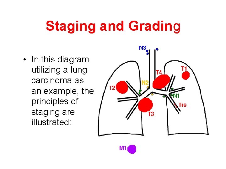 Staging and Grading • In this diagram utilizing a lung carcinoma as an example,