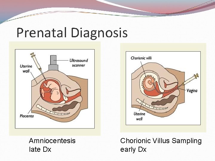 Prenatal Diagnosis Amniocentesis late Dx Chorionic Villus Sampling early Dx 