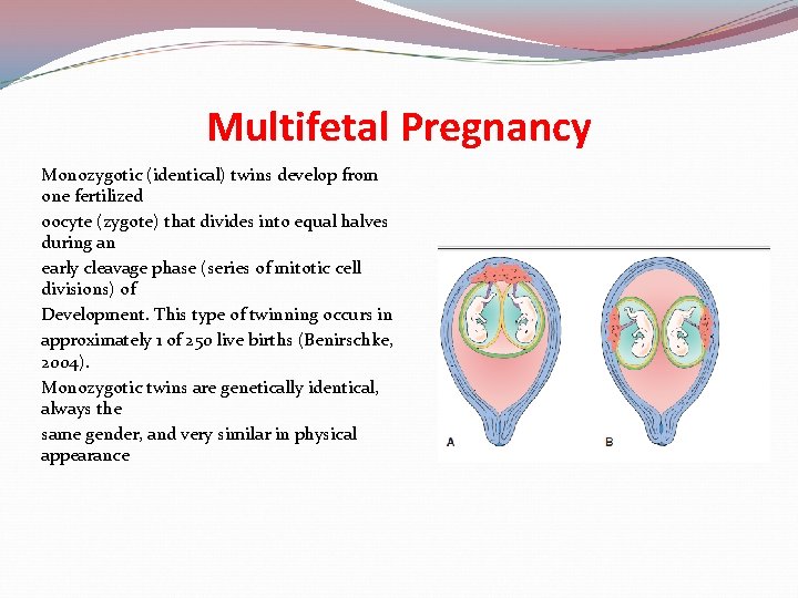 Multifetal Pregnancy Monozygotic (identical) twins develop from one fertilized oocyte (zygote) that divides into