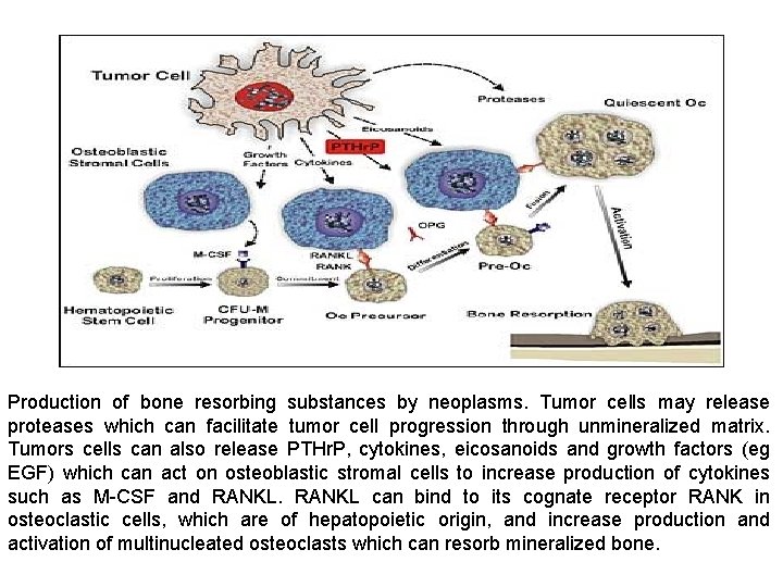 Production of bone resorbing substances by neoplasms. Tumor cells may release proteases which can