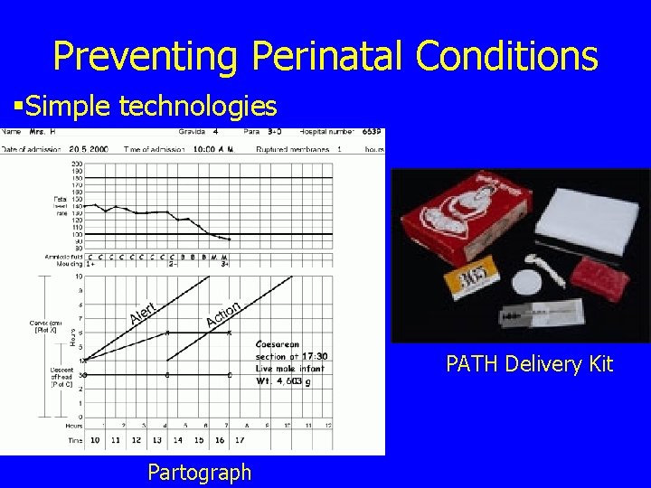 Preventing Perinatal Conditions §Simple technologies PATH Delivery Kit Partograph 