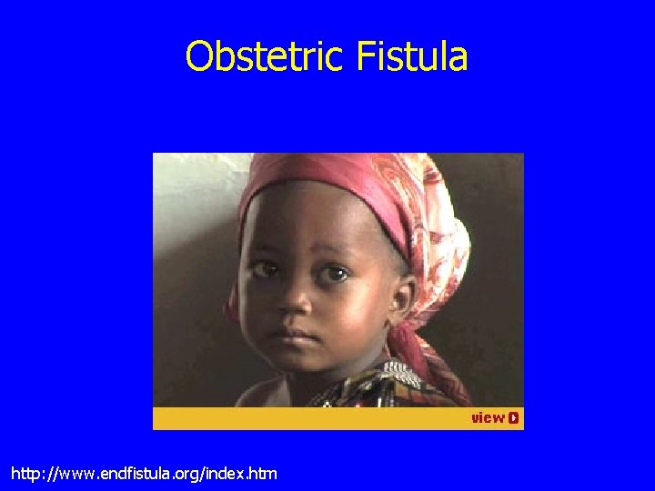 Obstetric Fistula http: //www. endfistula. org/index. htm 