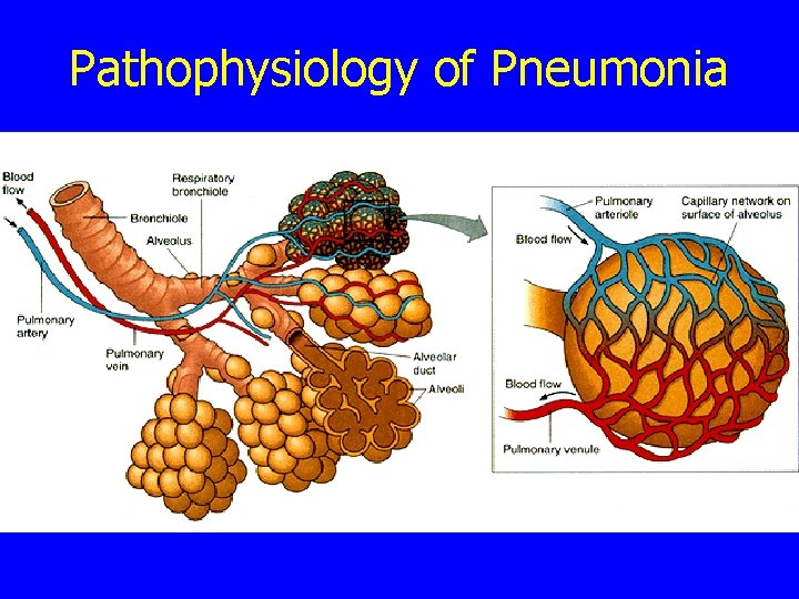 Pathophysiology of Pneumonia 