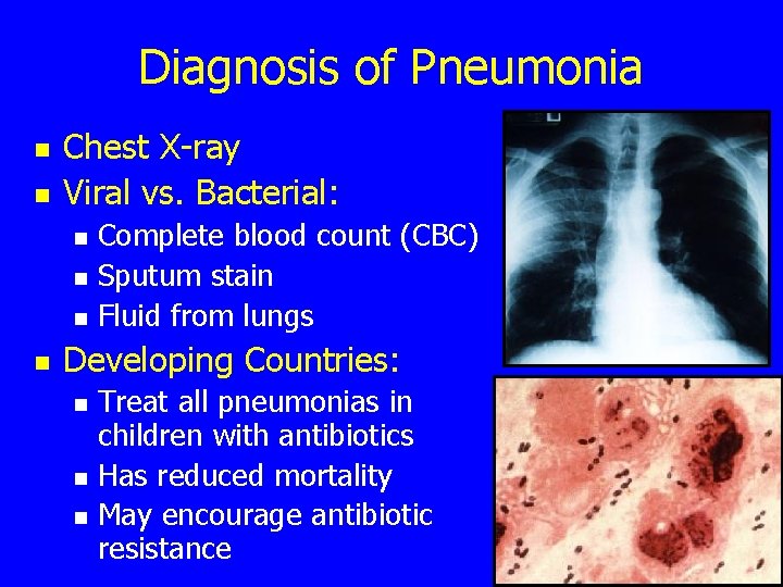 Diagnosis of Pneumonia n n Chest X-ray Viral vs. Bacterial: n n Complete blood