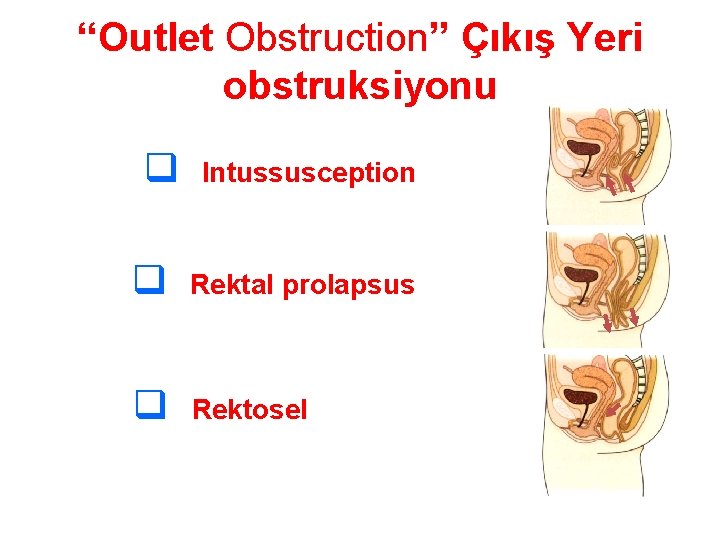 “Outlet Obstruction” Çıkış Yeri obstruksiyonu q Intussusception q Rektal prolapsus q Rektosel 