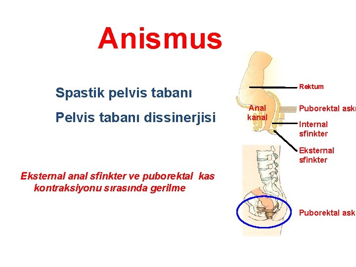 Anismus Rektum Spastik pelvis tabanı Pelvis tabanı dissinerjisi Anal kanal Puborektal askı Internal sfinkter