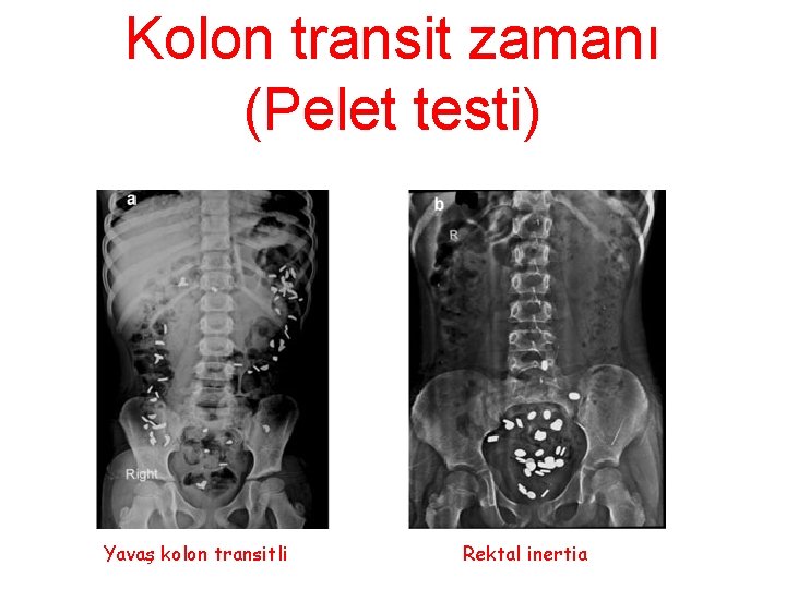 Kolon transit zamanı (Pelet testi) Yavaş kolon transitli Rektal inertia 