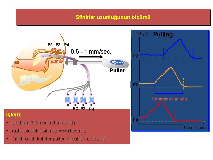 Sfinkter uzunluğunun ölçümü cm H 2 O Pulling P 2 P 3 P 4