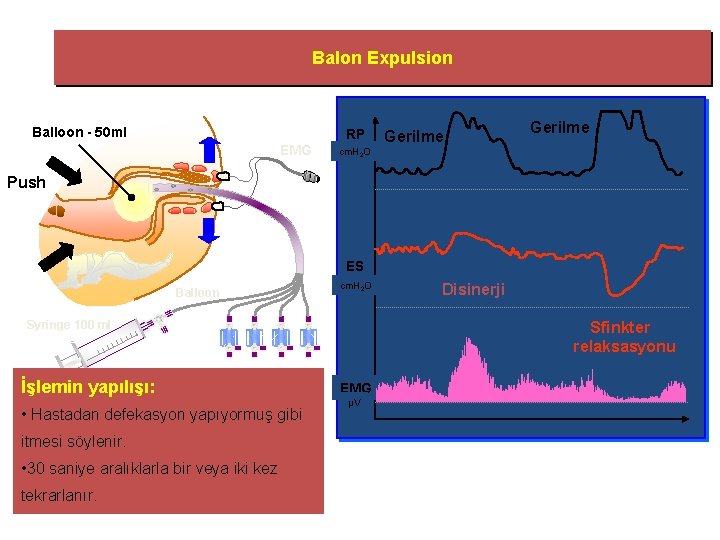 Balon Expulsion Balloon - 50 ml RP EMG Gerilme cm. H 2 O Push