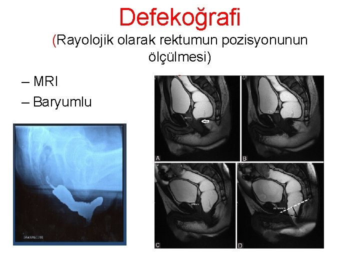 Defekoğrafi (Rayolojik olarak rektumun pozisyonunun ölçülmesi) – MRI – Baryumlu : 