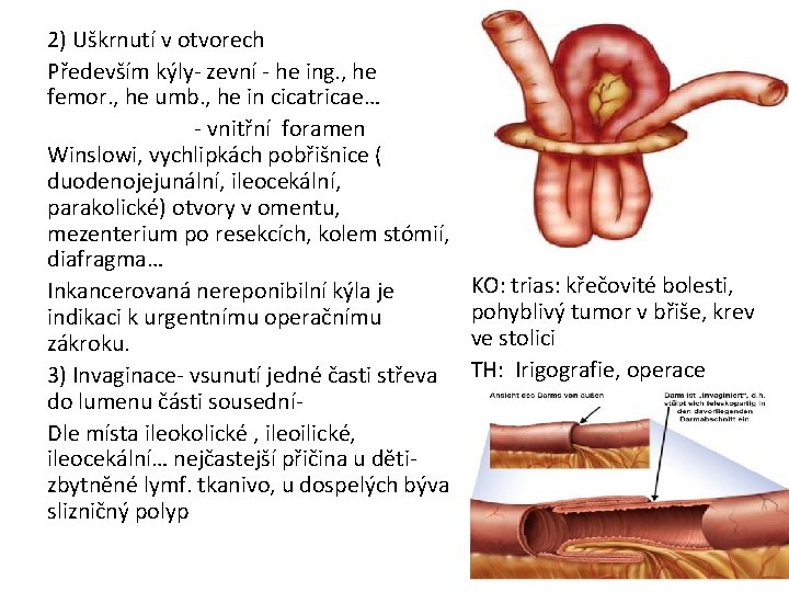 2) Uškrnutí v otvorech Především kýly- zevní - he ing. , he femor. ,