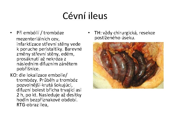 Cévní ileus • Při embólií / trombóze mezenteriálních cev, infarktizace střevní stěny vede k