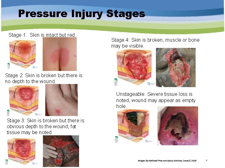 Pressure Injury Stages Stage 1: Skin is intact but red. Stage 4: Skin is