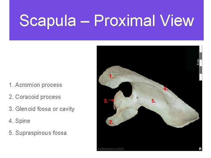 Scapula – Proximal View 1. Acromion process 2. Coracoid process 4. 3. 5. 3.