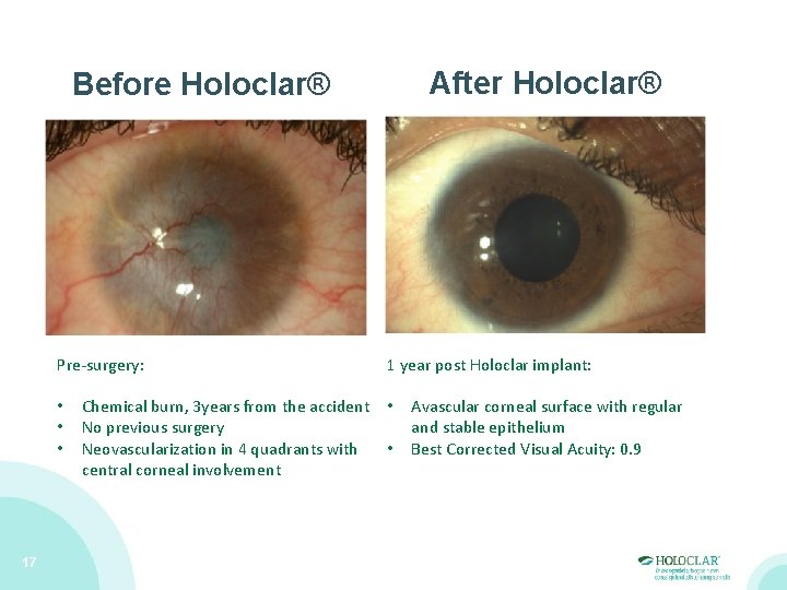 After Holoclar® Before Holoclar® Pre-surgery: • • • 17 1 year post Holoclar implant: