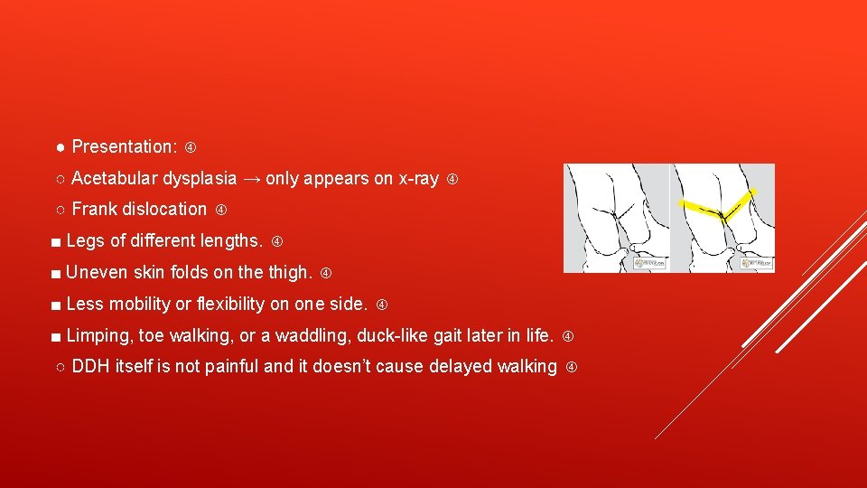 ● Presentation: ○ Acetabular dysplasia → only appears on x-ray ○ Frank dislocation ■