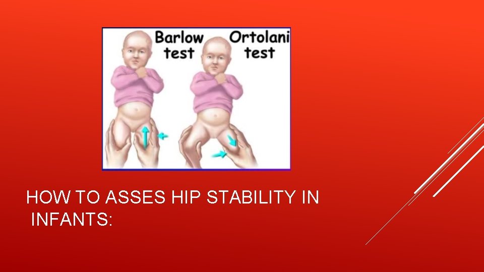 HOW TO ASSES HIP STABILITY IN INFANTS: 