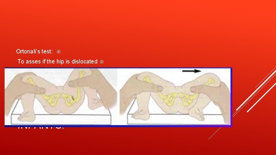 Ortonali’s test: To asses if the hip is dislocated HOW TO ASSES STABILITY IN