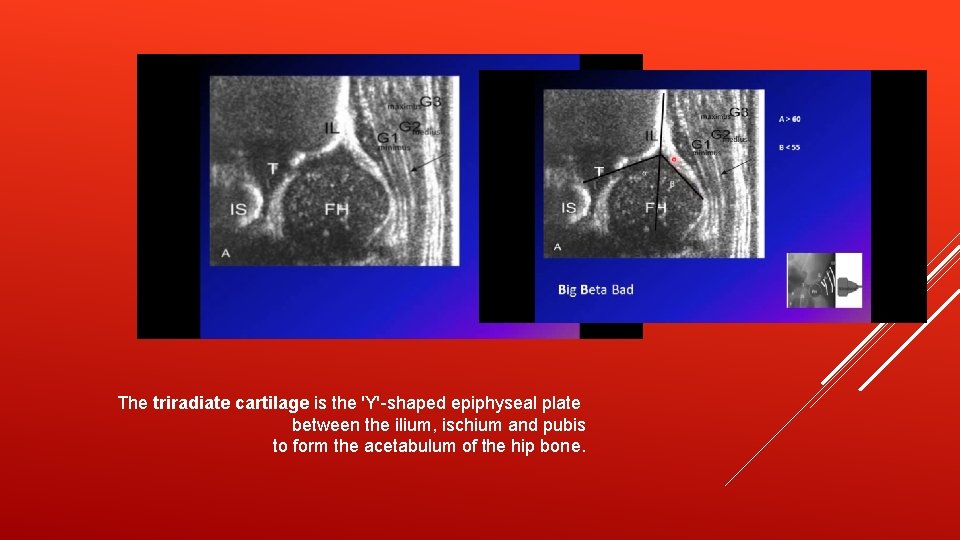 The triradiate cartilage is the 'Y'-shaped epiphyseal plate between the ilium, ischium and pubis