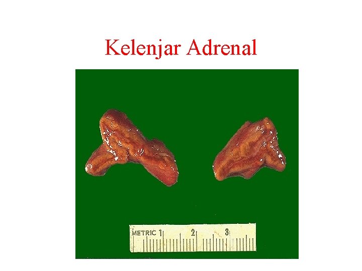 Kelenjar Adrenal 