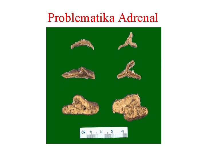 Problematika Adrenal 