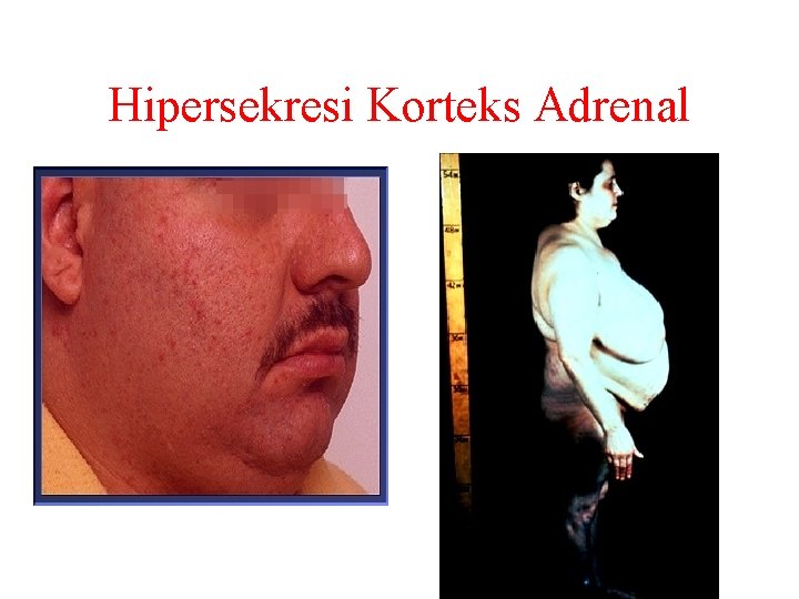 Hipersekresi Korteks Adrenal 