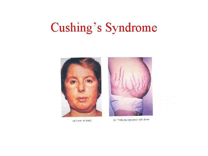 Cushing’s Syndrome 