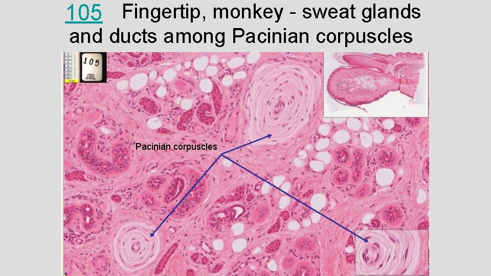 105 Fingertip, monkey - sweat glands and ducts among Pacinian corpuscles 