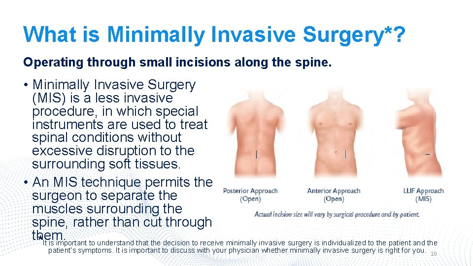 What is Minimally Invasive Surgery*? Operating through small incisions along the spine. • Minimally