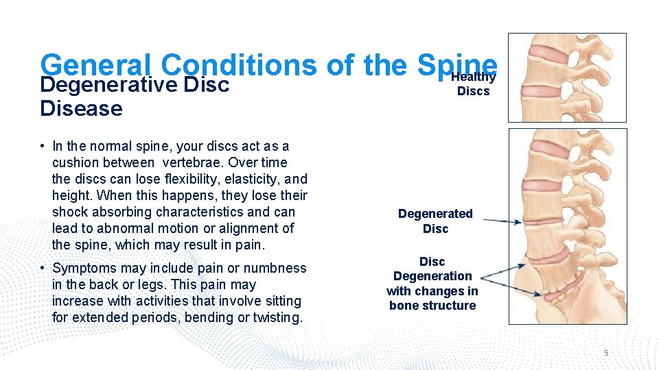 General Conditions of the Spine Healthy Degenerative Disc Disease • In the normal spine,