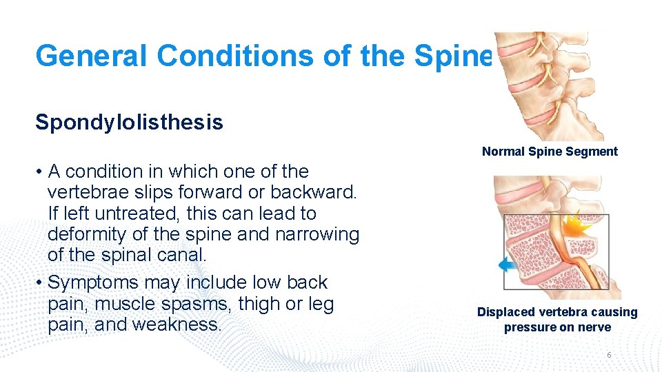 General Conditions of the Spine Spondylolisthesis Normal Spine Segment • A condition in which