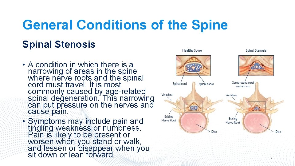 General Conditions of the Spinal Stenosis • A condition in which there is a