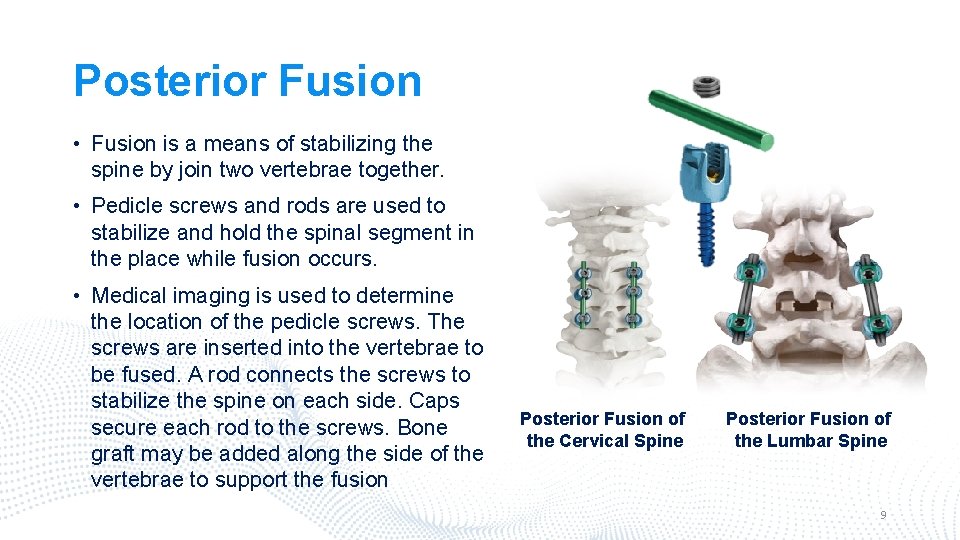 Posterior Fusion • Fusion is a means of stabilizing the spine by join two