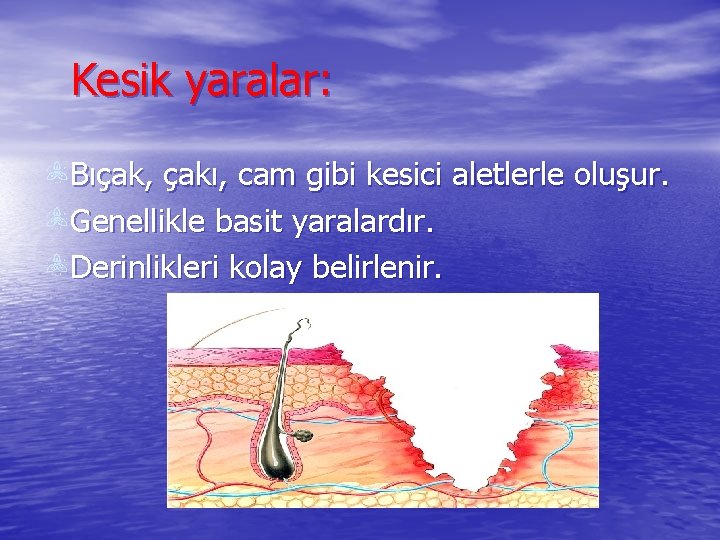 Kesik yaralar: Bıçak, çakı, cam gibi kesici aletlerle oluşur. Genellikle basit yaralardır. Derinlikleri kolay