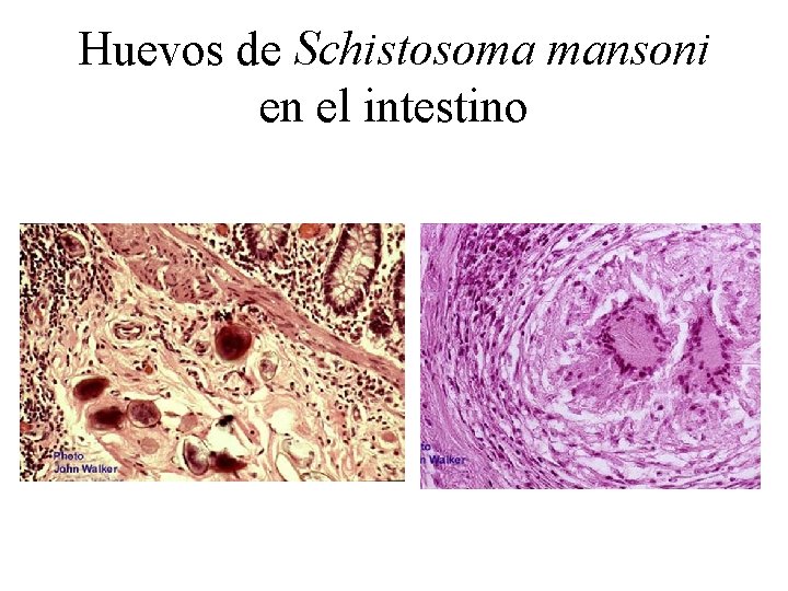 Huevos de Schistosoma mansoni en el intestino 