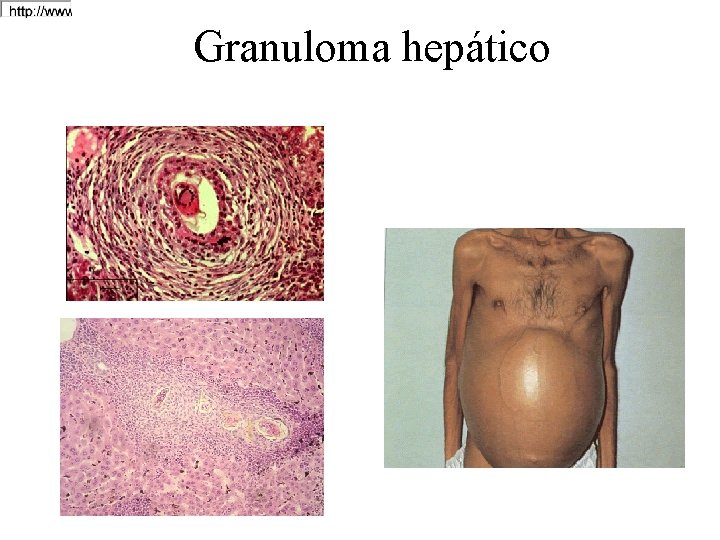 Granuloma hepático 