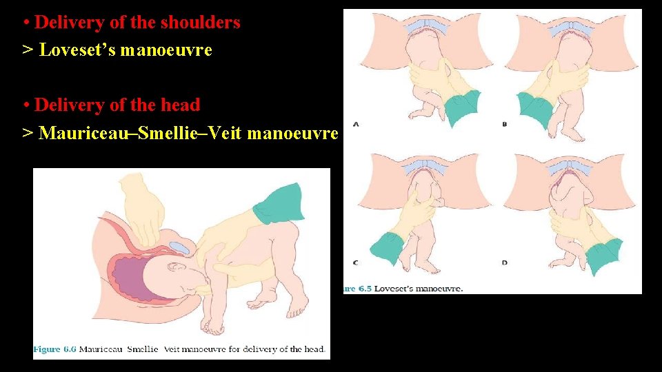  • Delivery of the shoulders > Loveset’s manoeuvre • Delivery of the head