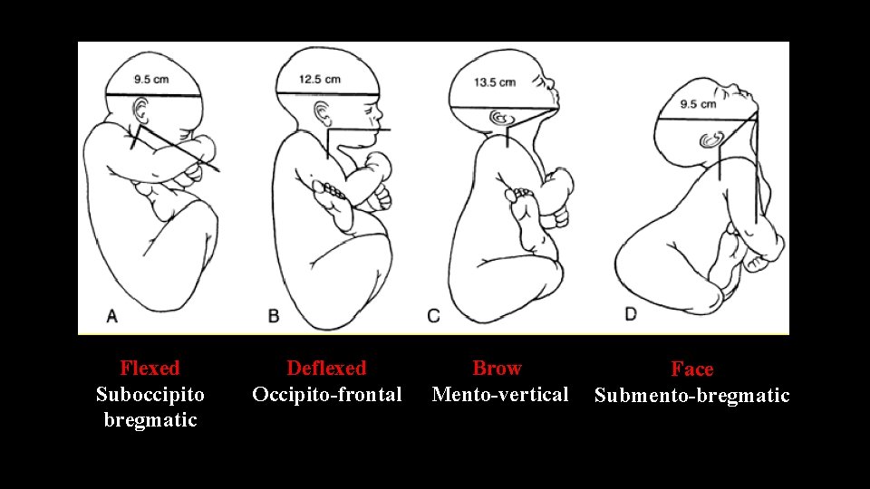 Flexed Suboccipito bregmatic Deflexed Occipito-frontal Brow Mento-vertical Face Submento-bregmatic 