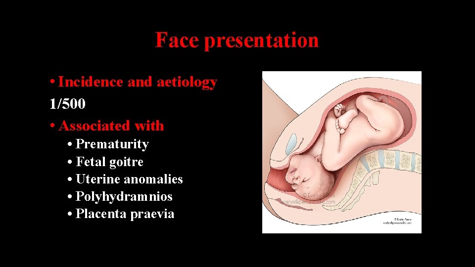 Face presentation • Incidence and aetiology 1/500 • Associated with • Prematurity • Fetal