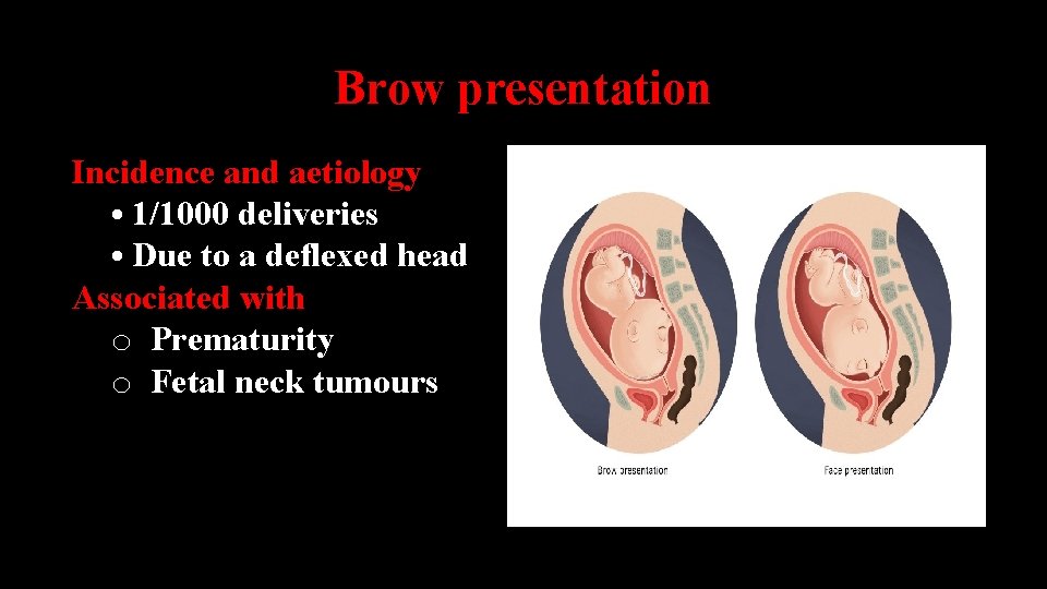 Brow presentation Incidence and aetiology • 1/1000 deliveries • Due to a deflexed head